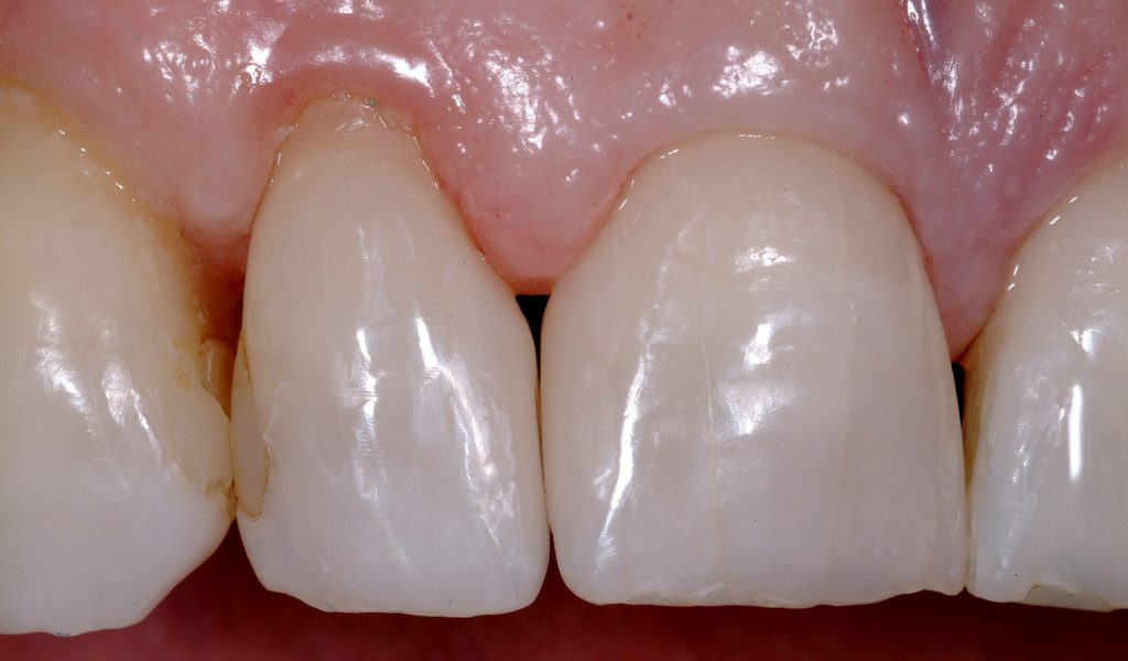 A Modern Day And Predictable Approach To Gingival Embrasures Optident